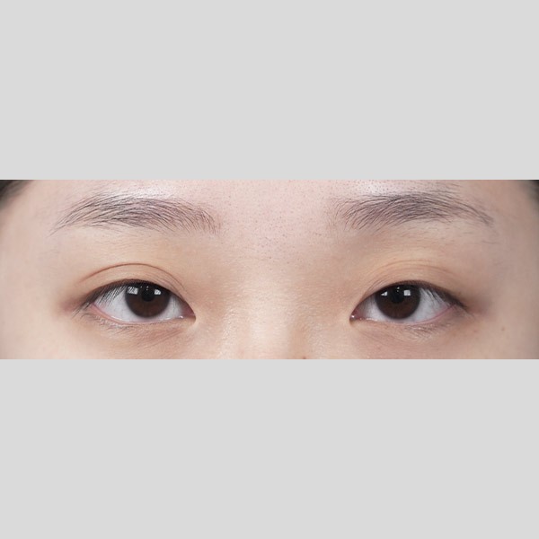 자연유착,앞트임