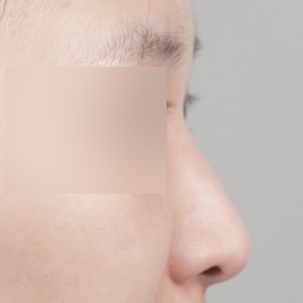 코끝,비중격,귀연골,매부리,복코,휜코,비순각