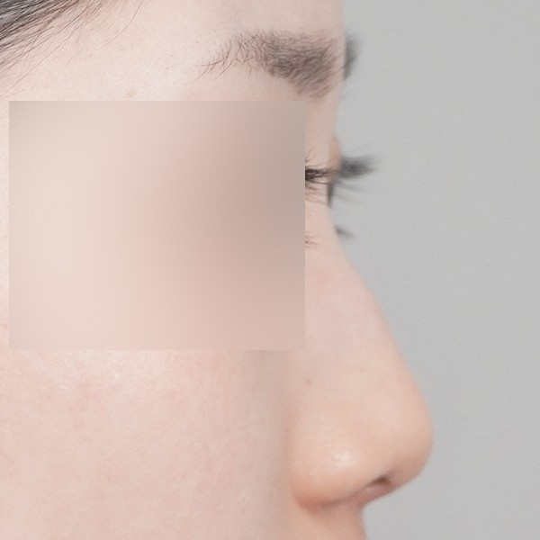 코끝,비중격,귀연골,매부리,복코,절골,짧은코